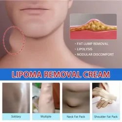 South Moon Lipoma Removal Cream