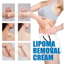 South Moon Lipoma Removal Cream