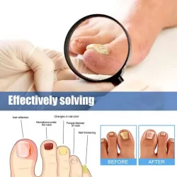 Toenail Fungus Treatment Patches