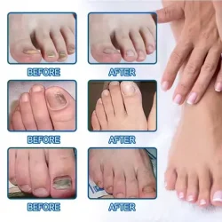 Toenail Fungus Treatment Patches