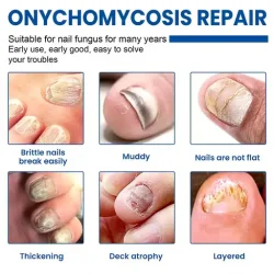 Toenail Fungus Treatment Patches